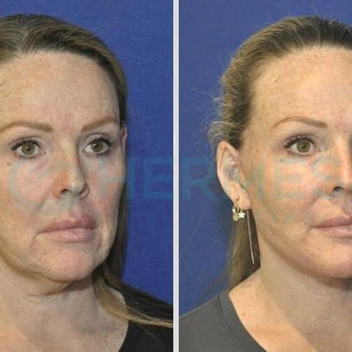 Before after photos of our patients 1